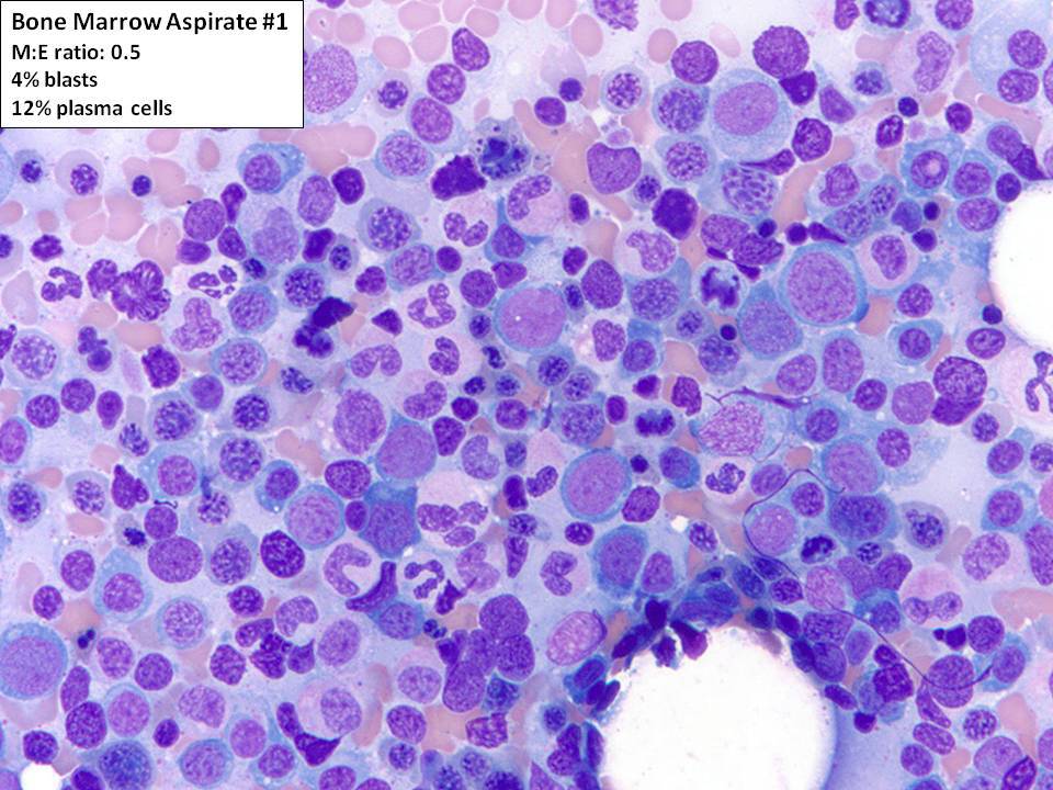 Bone marrow aspirate #1: The bone marrow aspirate shows erythroid-predominant trilineage hematopoiesis with prominent megaloblastoid erythroid precursors. Blasts are mildly increased (4%), and plasma cells comprise 12% of cells.